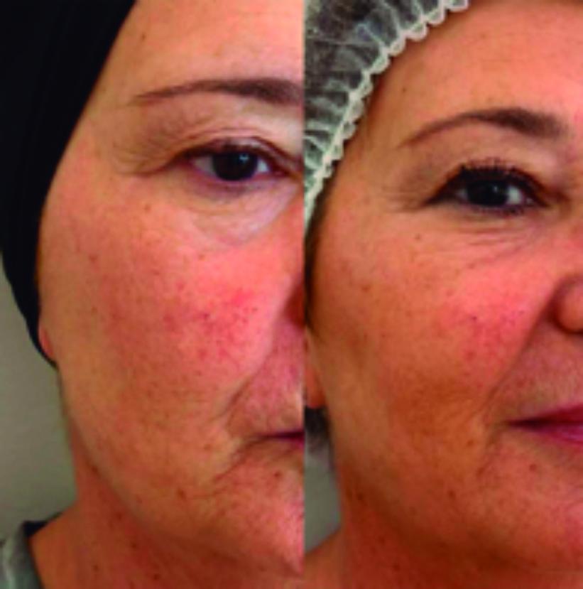 Antes y después de una clienta de Sapphira Privé La Coruña.