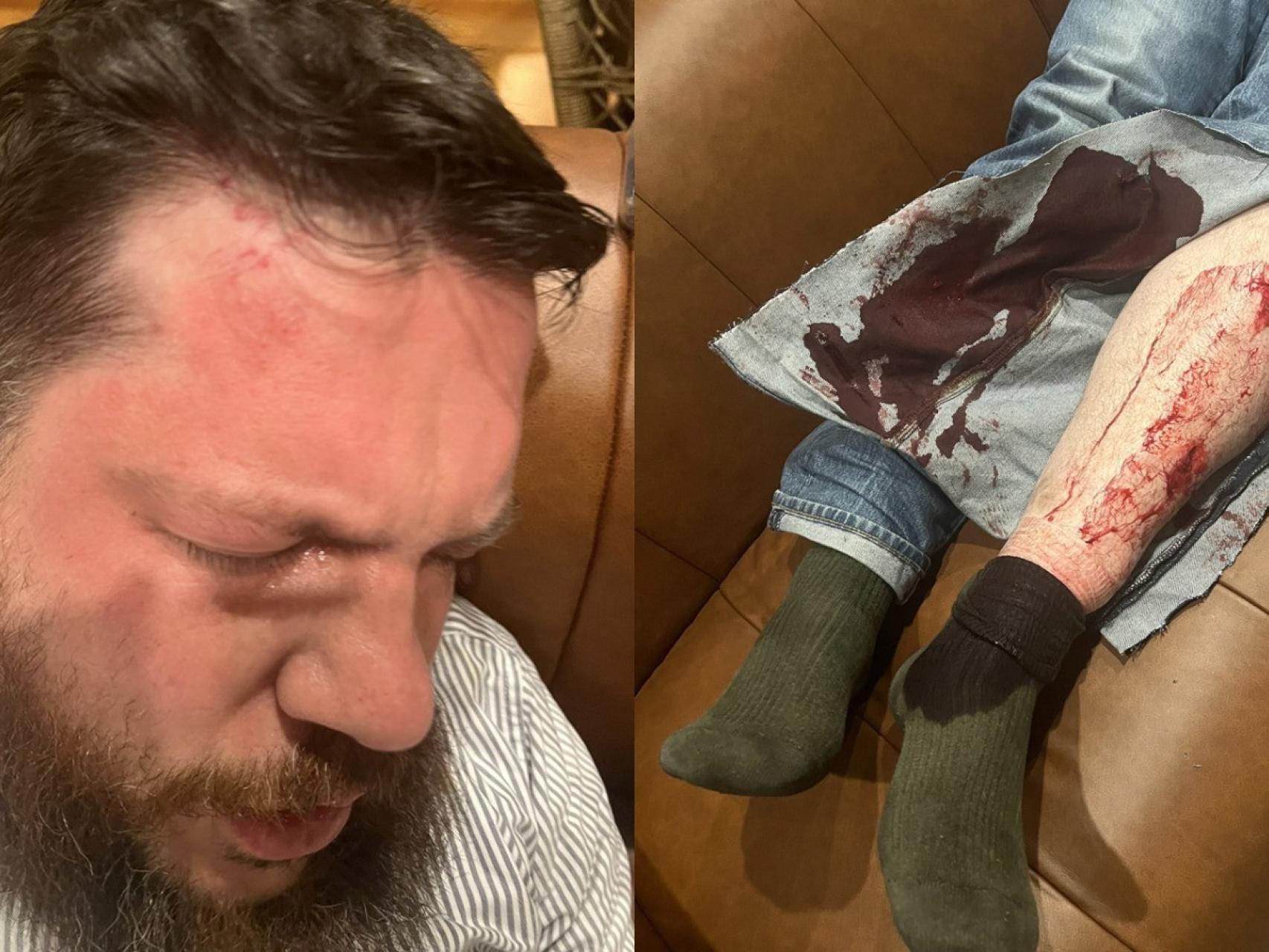 Leonid Volkov tras el ataque con martillo en Vilna, Lituania.