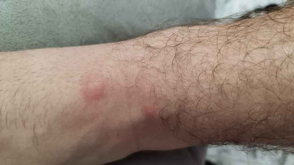 Picaduras y enrojecimiento de la piel.