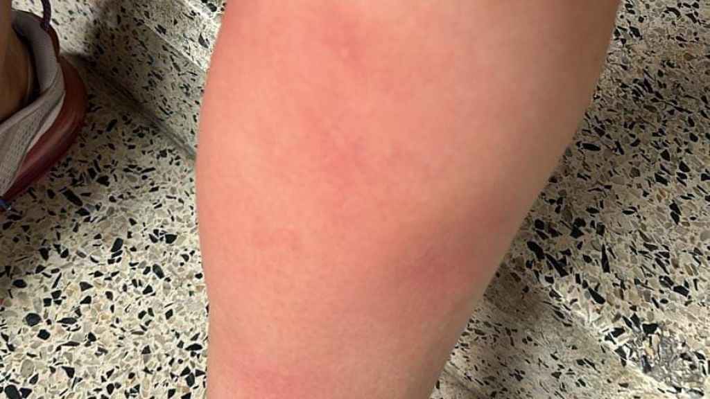 Picaduras y enrojecimiento de la piel.