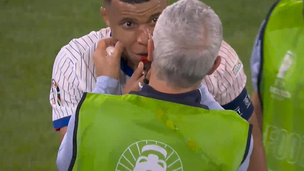 Kylian Mbappé, ensangrentado tras un golpe en la cara