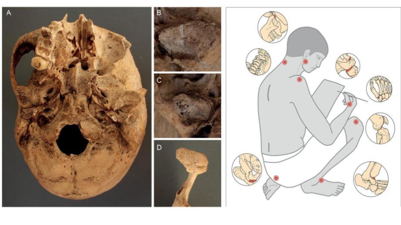 Ilustración descriptiva de los principales daños documentados en los esqueletos de un escriba junto a sus evidencias fotográficas.