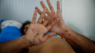 Un persona con viruela del mono.