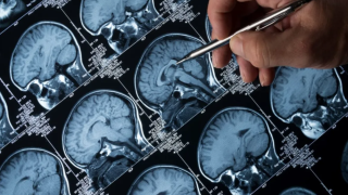 Un estudio respalda la eficacia de cenobamato en pacientes con epilepsia no controlada en la práctica clínica real