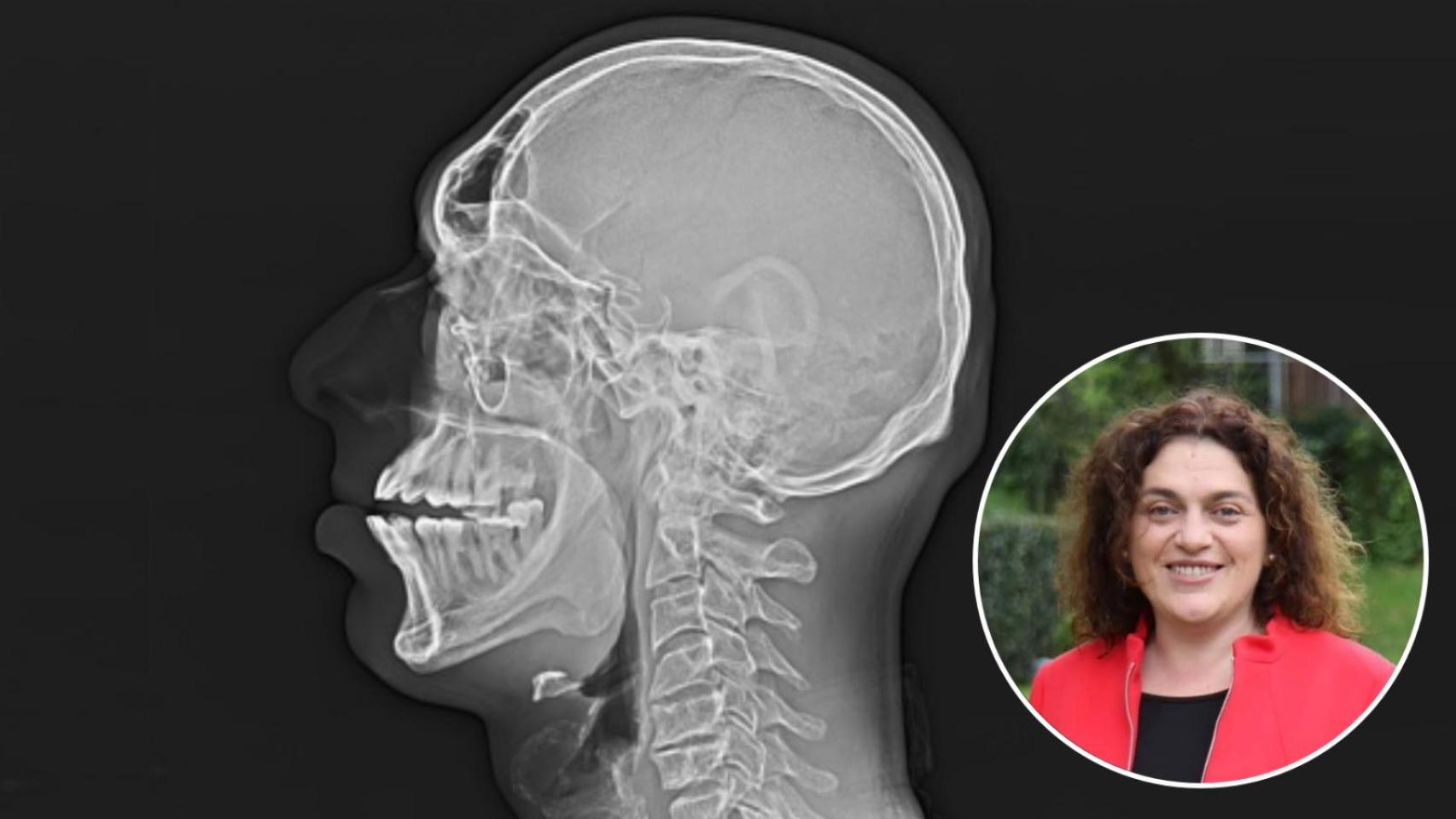 Montaje de una radiografía de un paciente con acromegalia y una imagen de Begoña Madariaga.