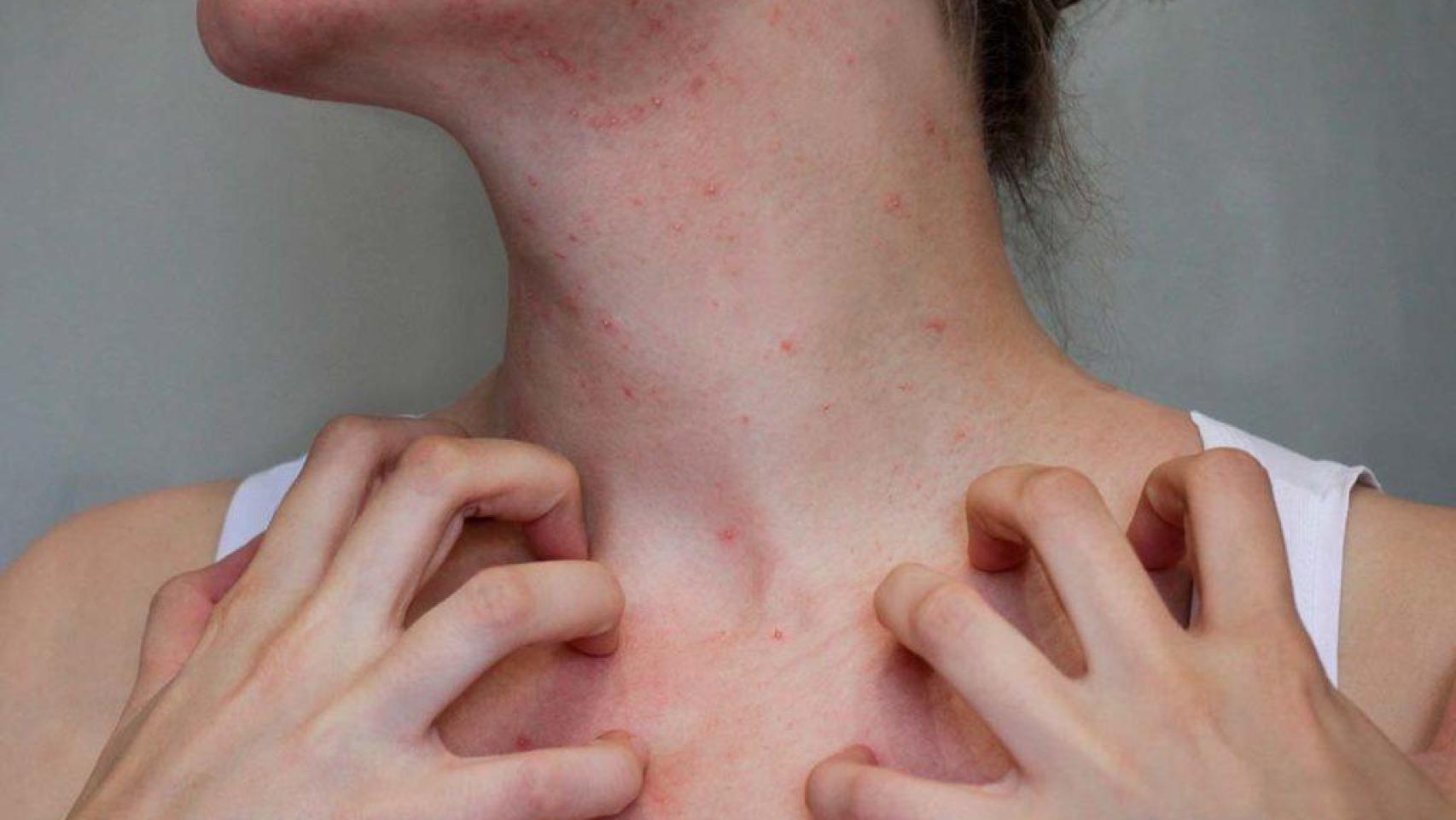 Una persona con sarna.