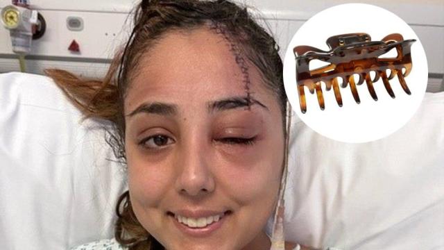 Jeena Panesar, superviviente de un accidente de tráfico en el que se clavó su pinza del pelo en el cráneo.