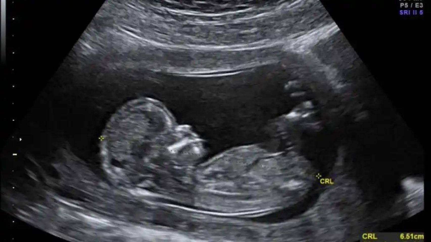 La madre tomaba el medicamento que le llegaba al feto a través de la placenta.