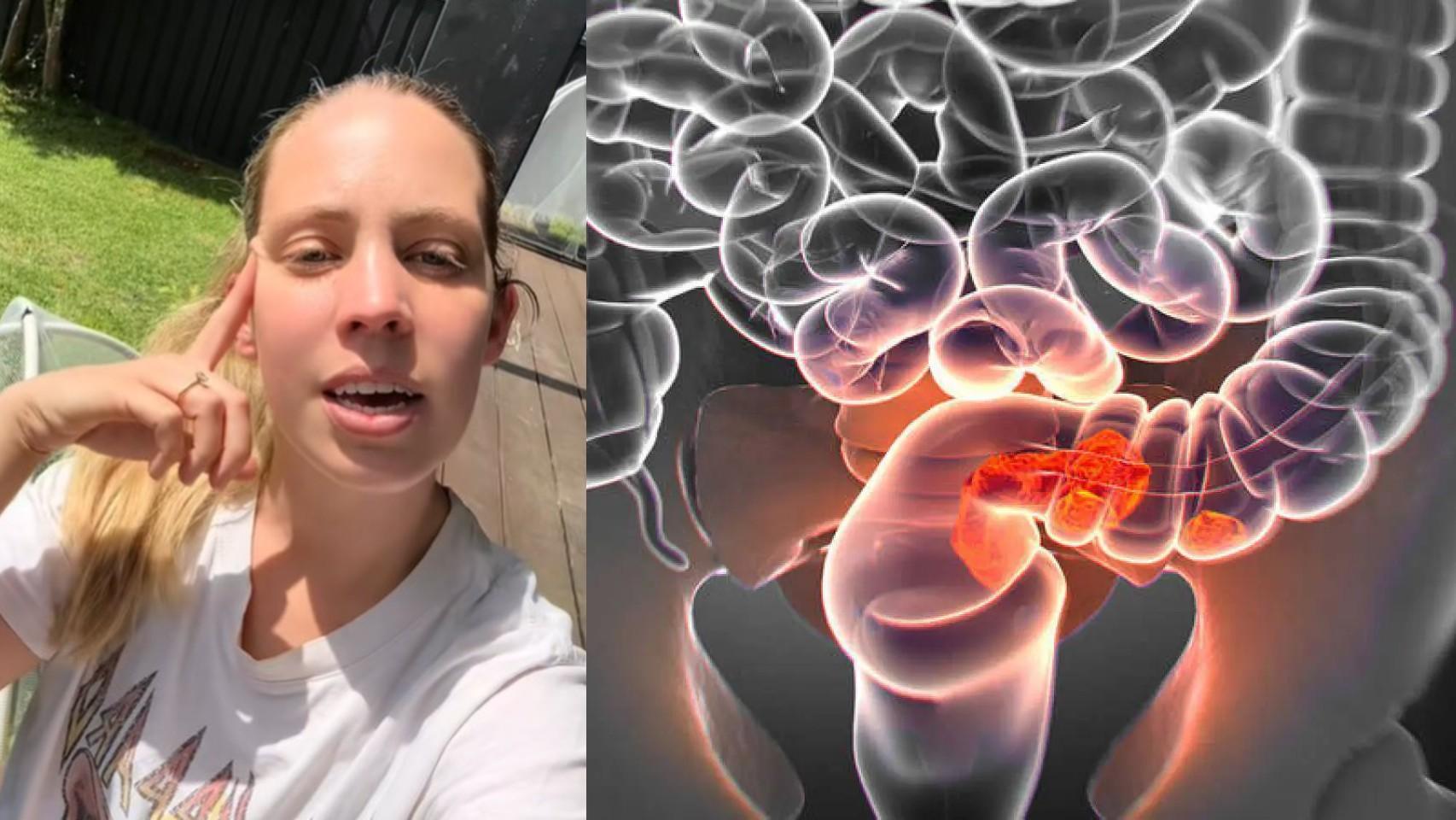 Tess, superviviente de cáncer de colon a los 33 años.