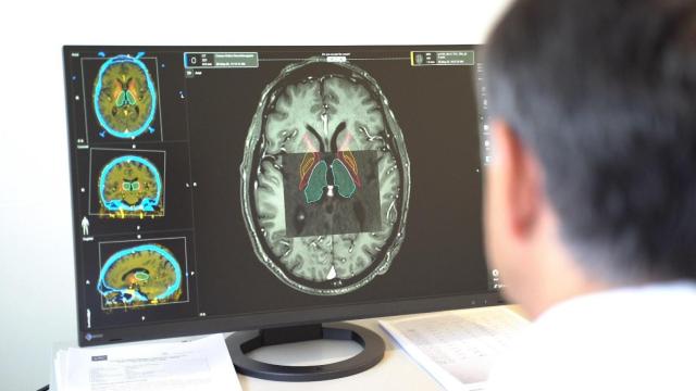 Escáner cerebral de un paciente con párkinson.