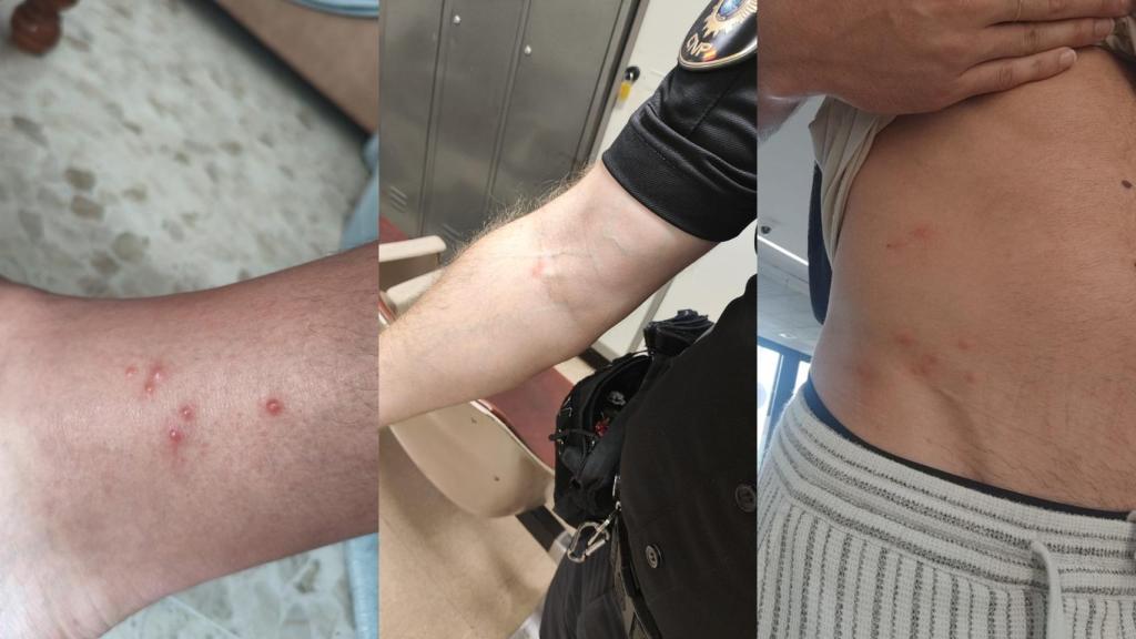 Policías del aeropuerto de Barajas con picaduras de chinches.