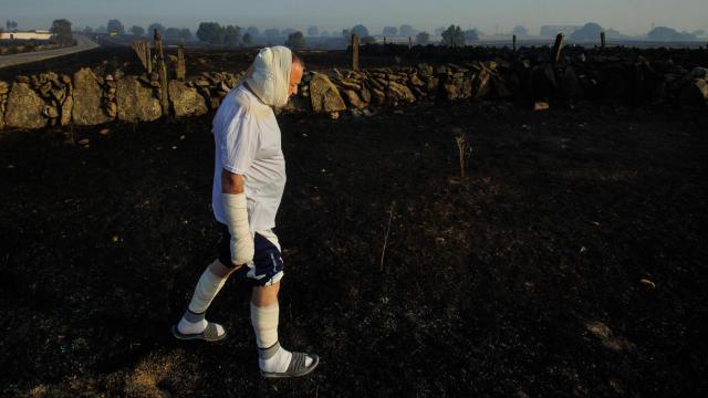 José Manuel Blanco, con quemaduras en varias partes del cuerpo, observa la zona arrasada por el incendio forestal de Ciperez (Salamanca)