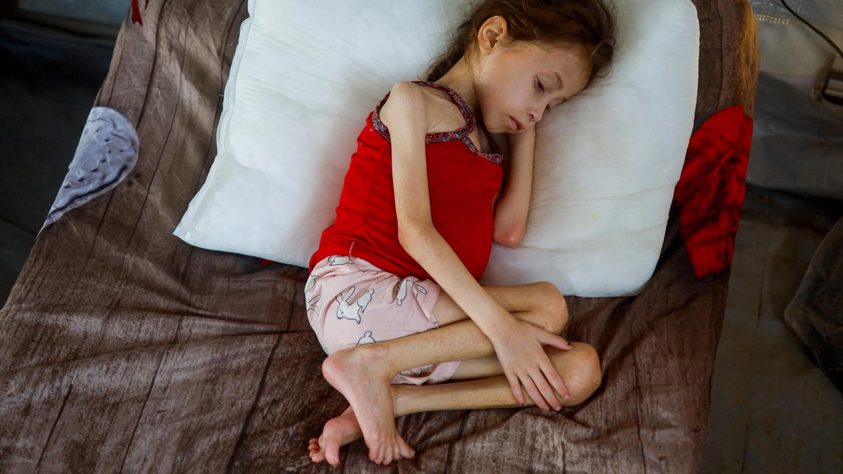 Una niña palestina con malnutrición.