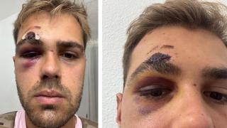 Un joven madrileño busca al agresor que le desfiguró la cara en la Feria de Málaga: "Me pegaron por diversión"