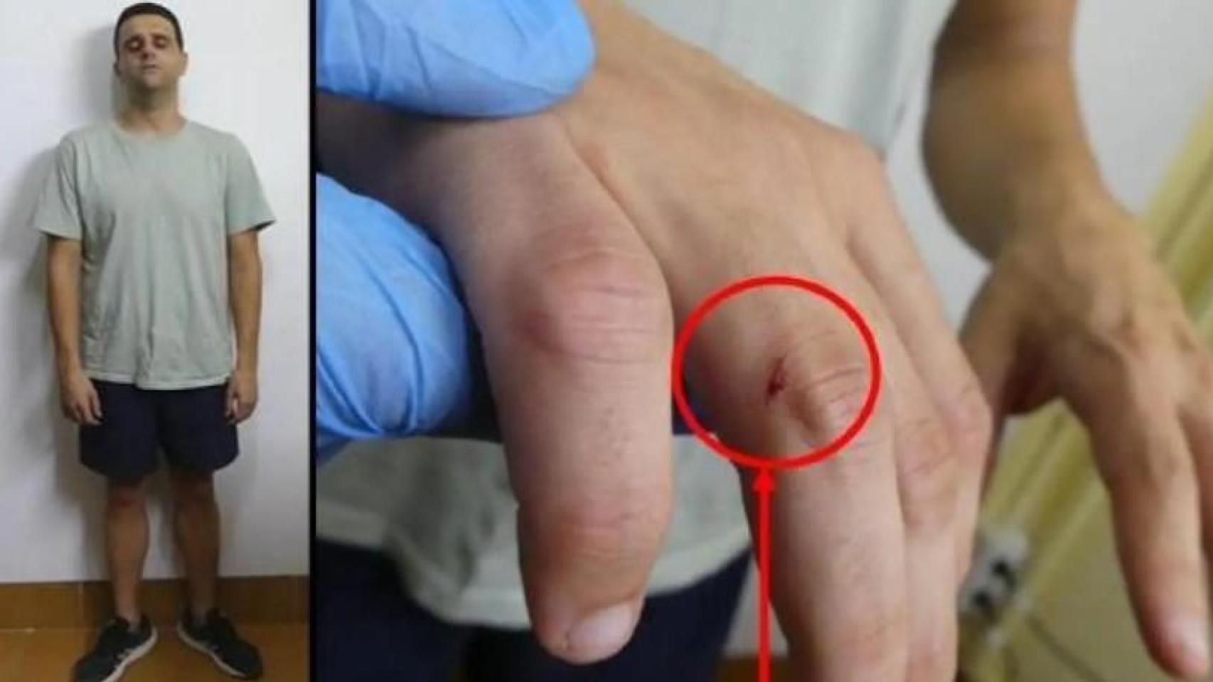 Felipe junior, tras ser detenido, junto a una imagen de su puño lesionado tras darle una paliza a su padre.