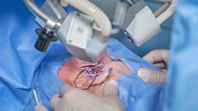 Operación de cataratas.