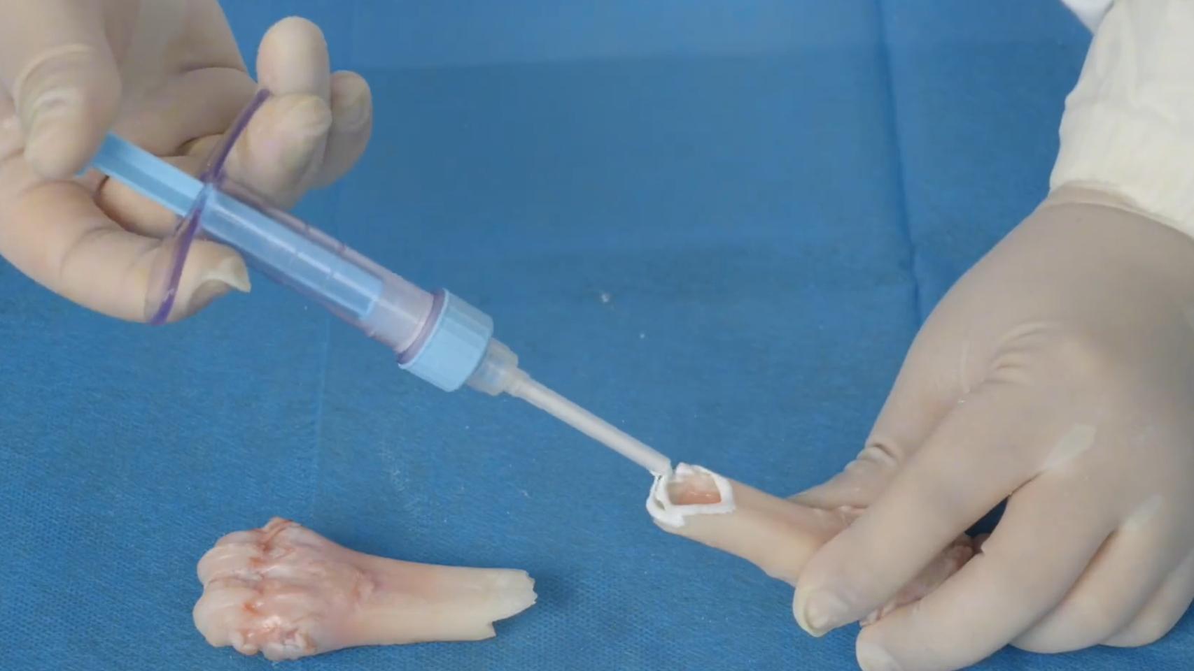 Un médico inyectado el biopegamento Bone 02 en un hueso.