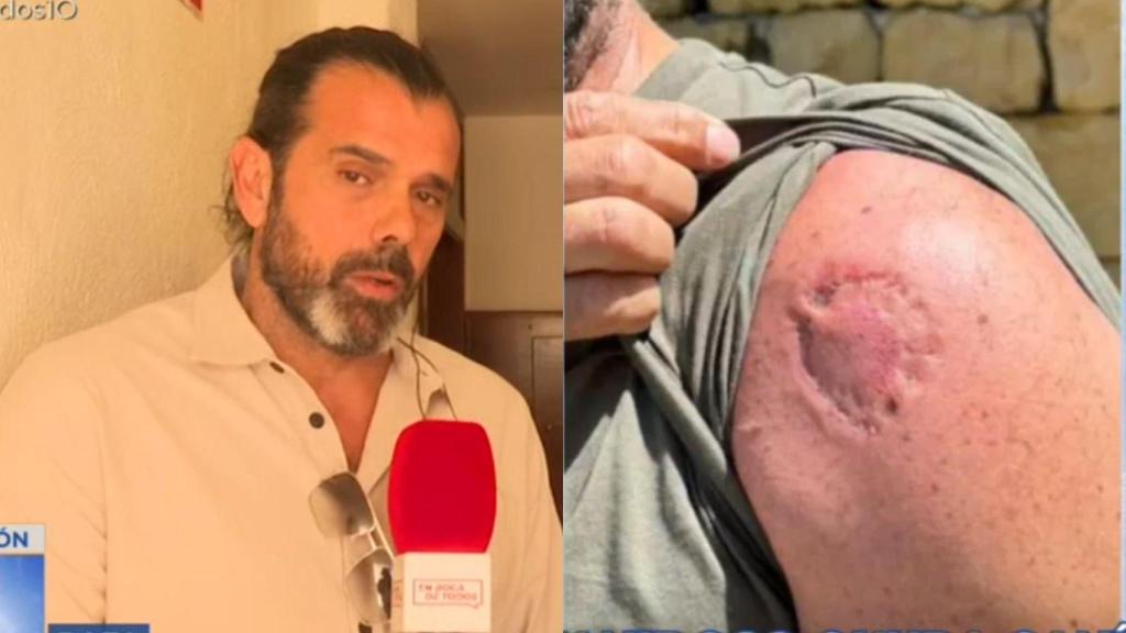 Imagen de Rafa, el propietario, y el mordisco del okupa.