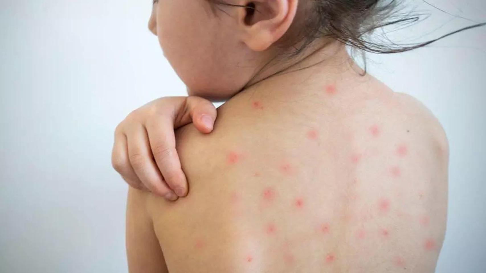España sufre sus mayores brotes de sarampión en 10 años mientras la cobertura vacunal cae en 15 de las 17 comunidades