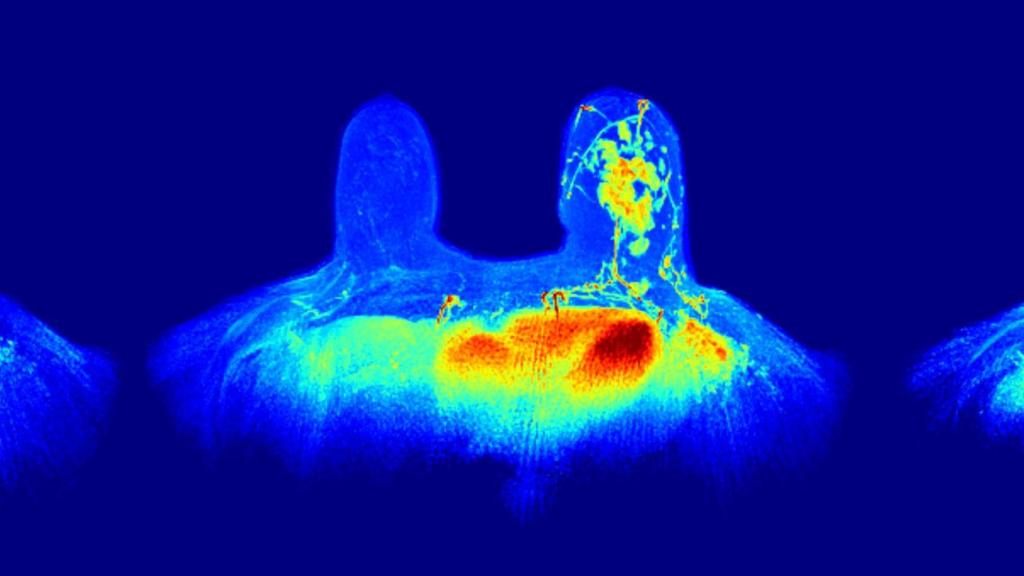 Mapa de resonancia magnética mamaria