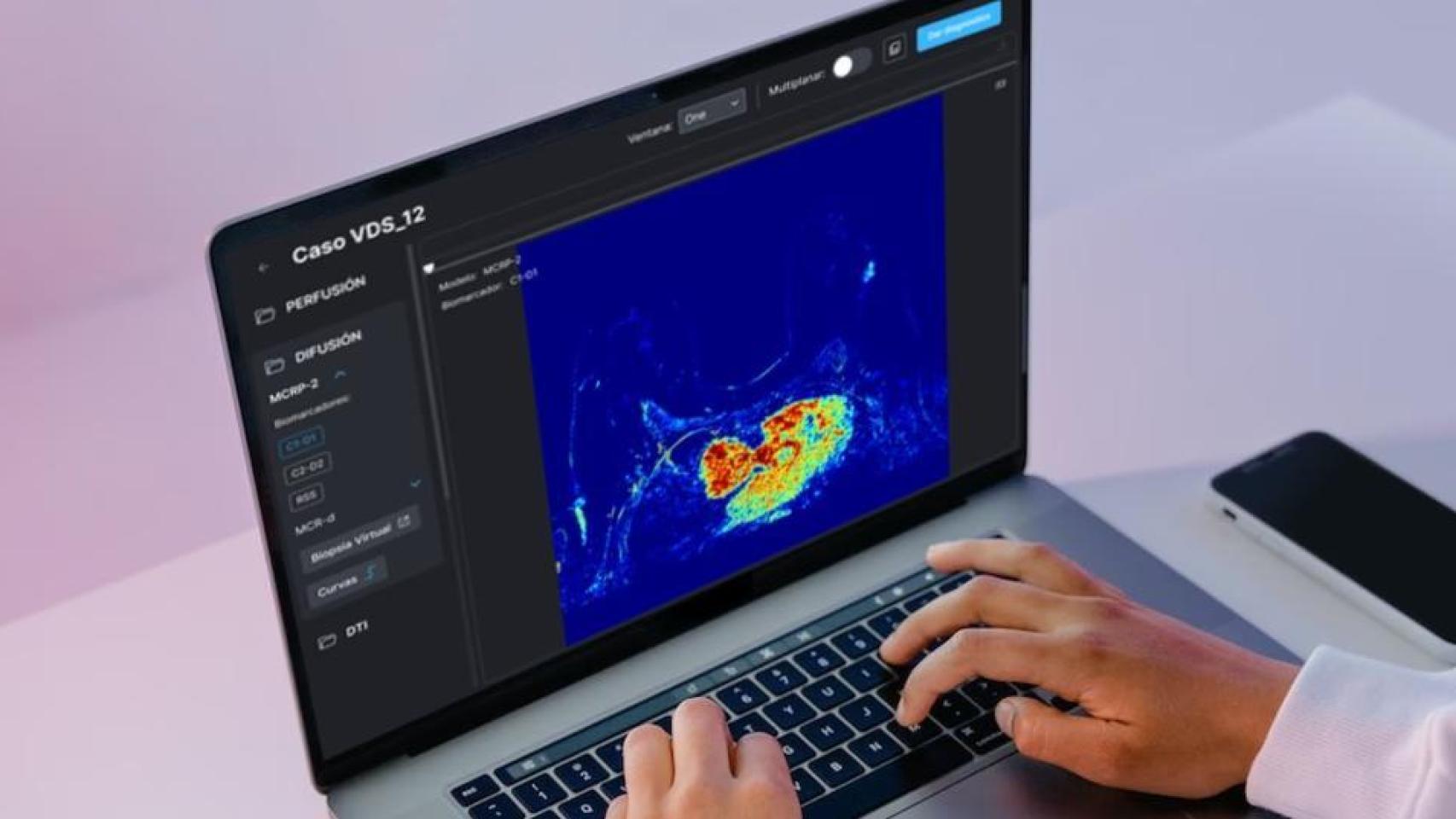 El sistema español para acelerar la detección precoz de cáncer de mama usando IA: "Encontramos tumores del tamaño de un pixel"
