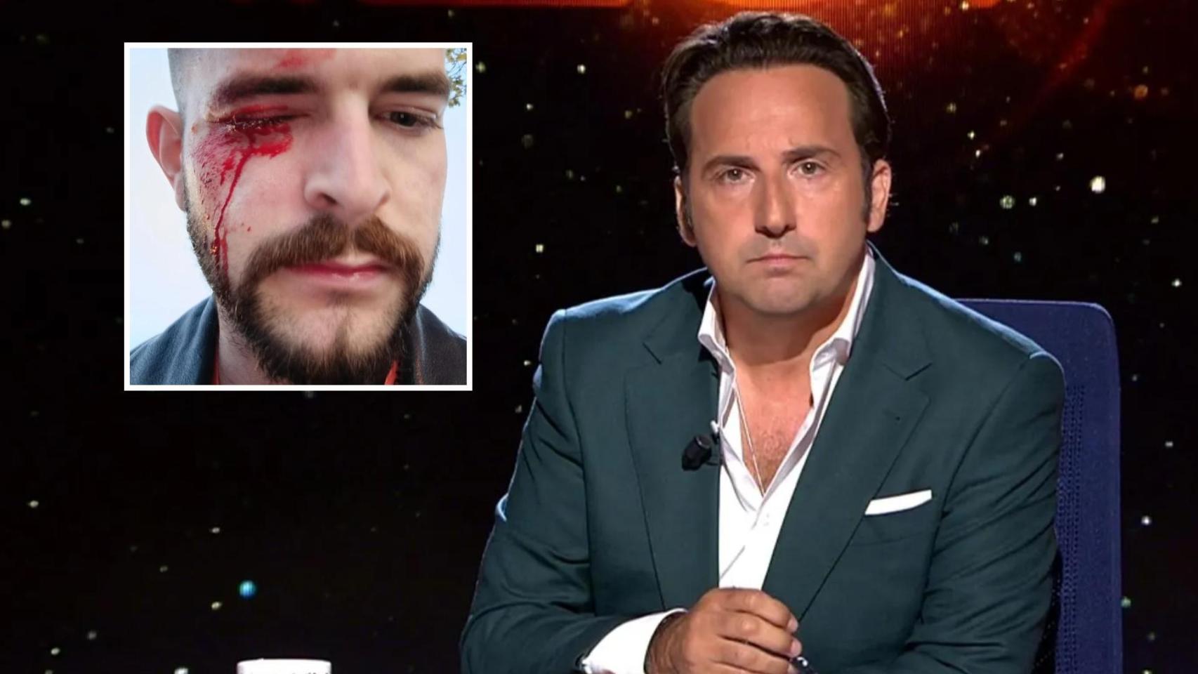 Imagen de José Ismael Martínez tras ser agredido en Pamplona e Iker Jiménez en el plató de 'Horizonte'.